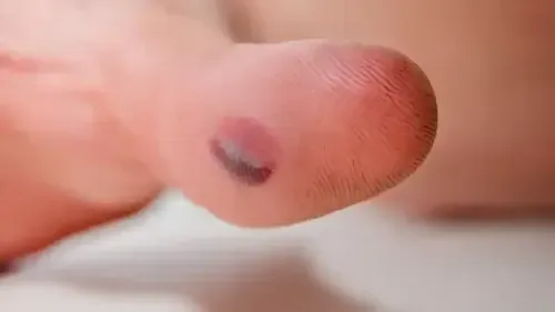 Symptoms of Blood Blisters - Causes Treatment and Prevention